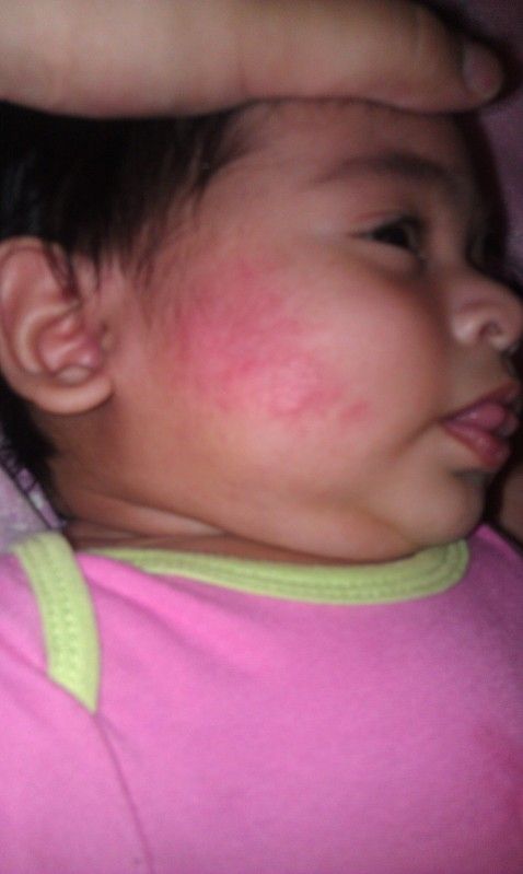 baby facial rashes