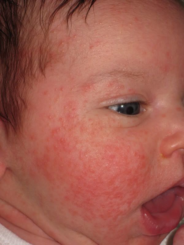 Newborn Acne Face And Chest