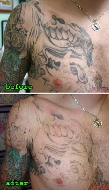laser tattoo remover